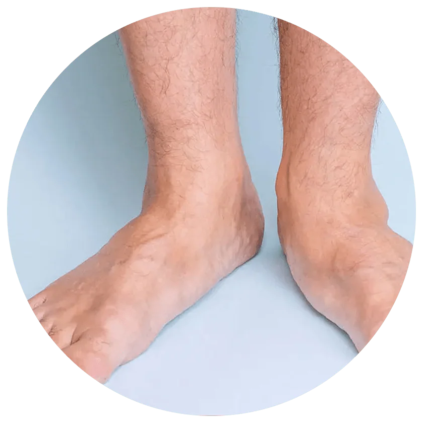 Flat Feet