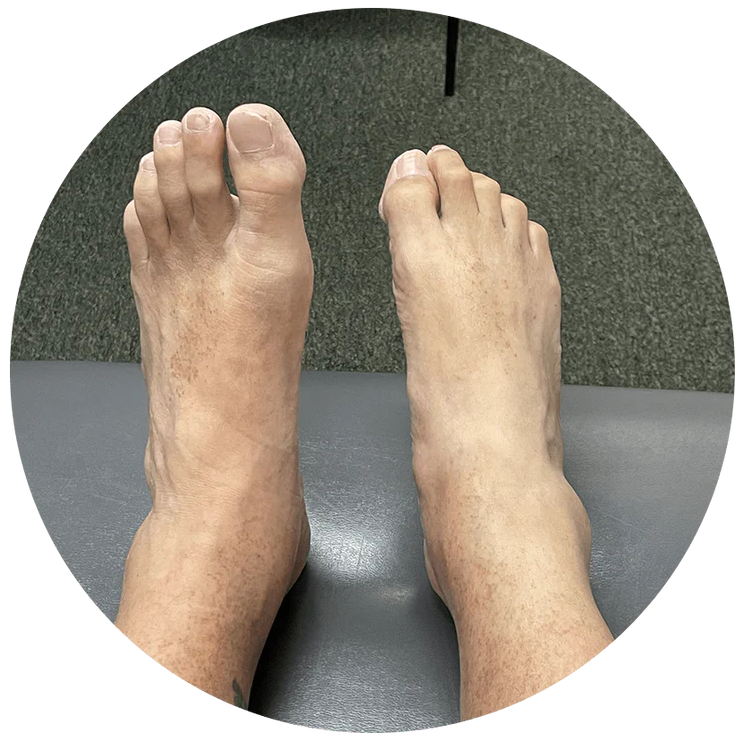 Drop Foot