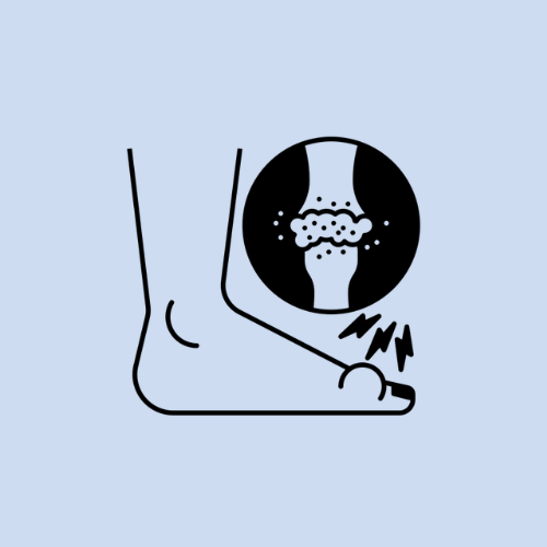 Morton's Neuroma