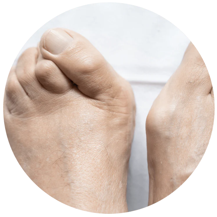 Hammer Toes