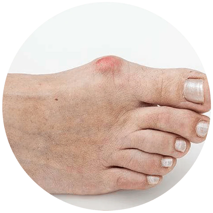 Bunions
