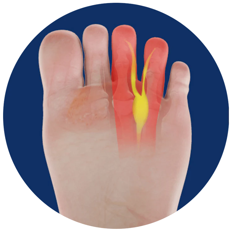 Morton's Neuroma