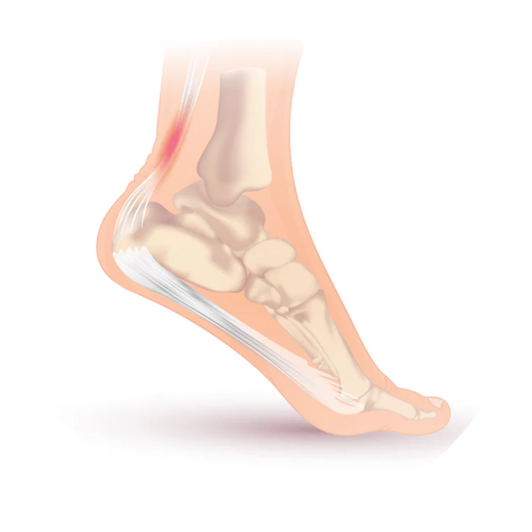 Achilles Tendinitis