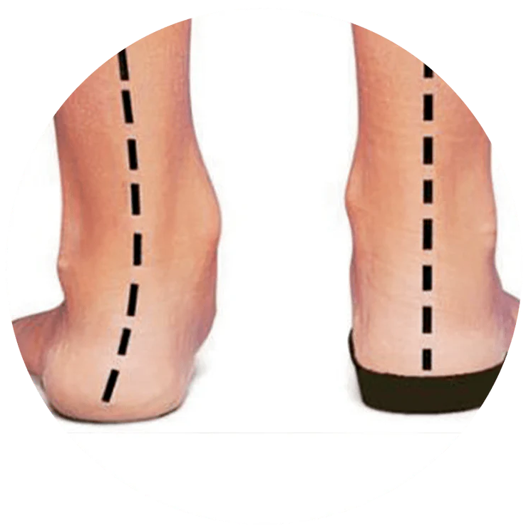 Pronation